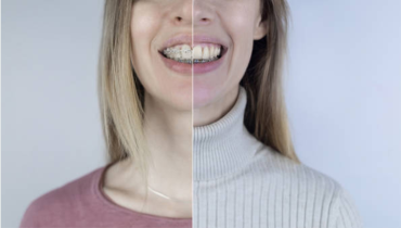 Dental Invisalign and Clear Aligners Before and After 2023